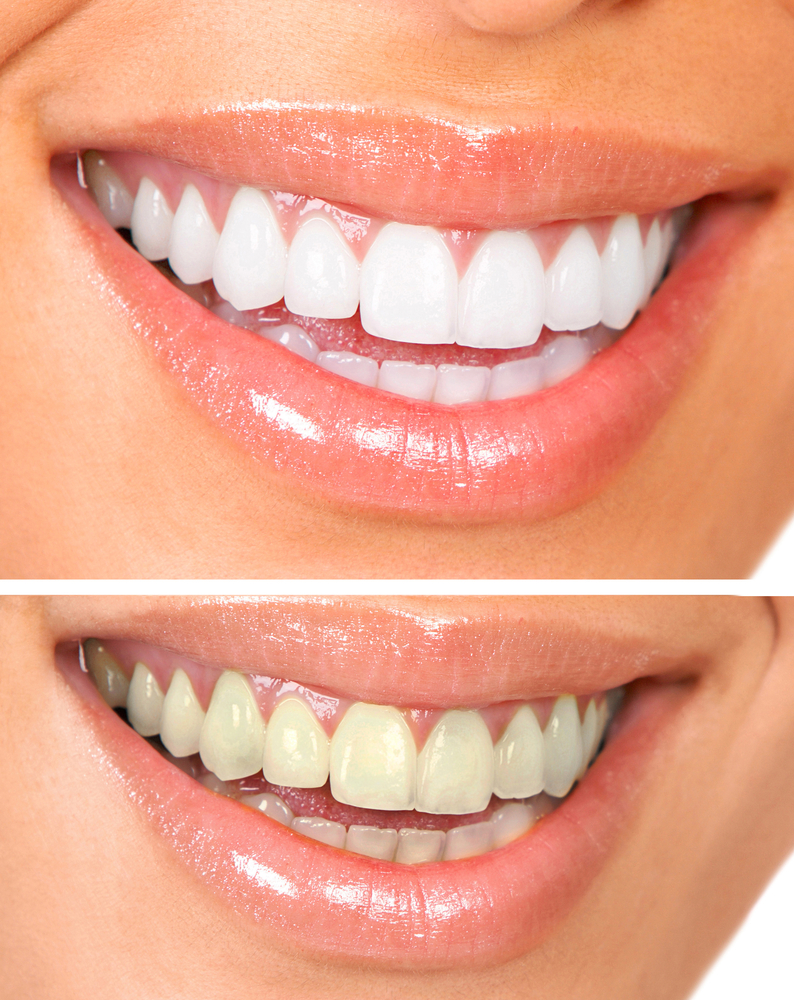 teeth whitening